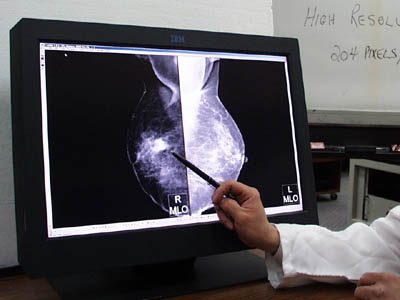 Syndrom Li-Fraumeni (LFS) je geneticky podmíněné onemocnění charakterizované obecně zvýšeným rizikem vzniku nádorového onemocnění. Popsali ho  Frederick Pei Li a Joseph F. Fraumeni jr. v roce 1969. Projevuje se mnohačetným nádorovým bujením v různých