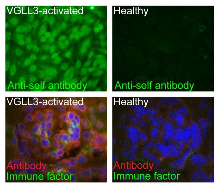 Rozdíly v přítomnosti autoimunitních protilátek a imunitních faktorů v krvi (nahoře) a ledvinách (dole) u myší s nadbytkem VGLL3 (levý sloupec) ve srovnání se zdravými myšmi (pravý sloupec). Kredit: University of Michigan.