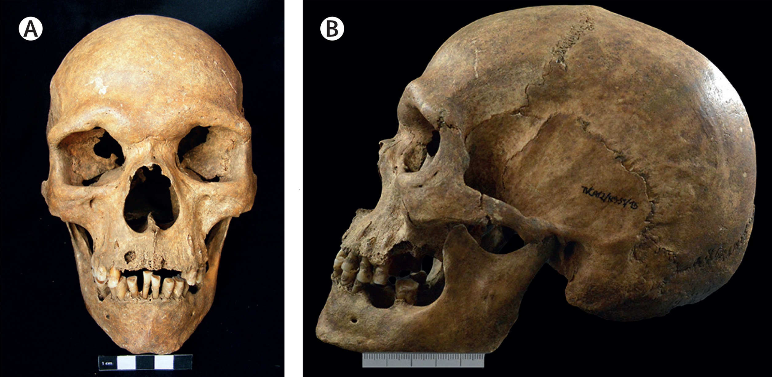 1000 let stará lebka středověkého muže s Klinefelterovým  syndromem - přední (A) a boční (B) pohled odhaluje nesymetrické opotřebení zubů způsobené pravděpodobným křivým růstem stěsnaných a špatně skloněných zubů v důsledku vyčnívající horní čelisti 