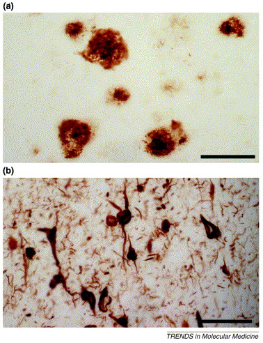 Amyloidní plaky (a) obarvené protilátkou proti amyloidu beta. Měřítko: 125 µm. Neurofibrilární klubka (b) barvená protilátkou proti helikálním vláknům hyperfosforylovaného proteinu tau. Měřítko: 62,5 µm. (Zdroj: LaFerla, F. M., & Oddo, S. (2005). Alz