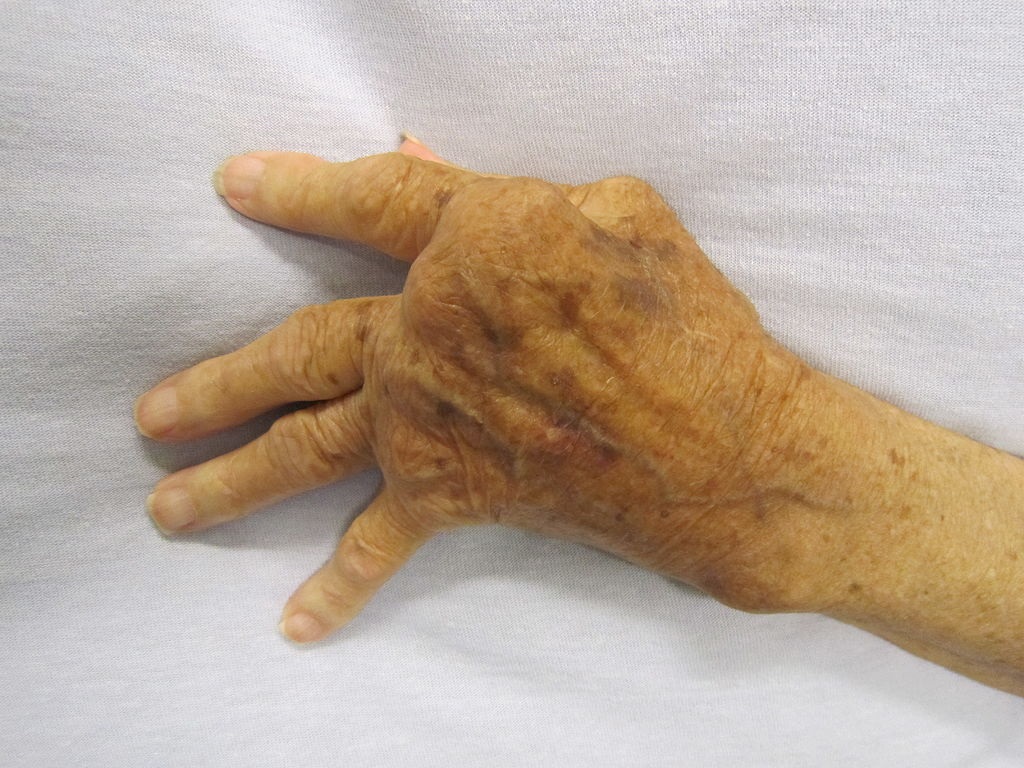 Těžká forma reumatoidní artritídy. U žen je 2–3× častější. Kredit: James Heilman, Wikipedia.