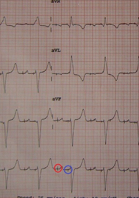 EKG pacienta s fungujúcim kardiostimulátorom, jeho impulzy sú zakrúžkované: stimulujúci predsiene je červený, komory modrý. Kredit: James Heilman, MD, Wikipedia. CC BY-SA 3.0