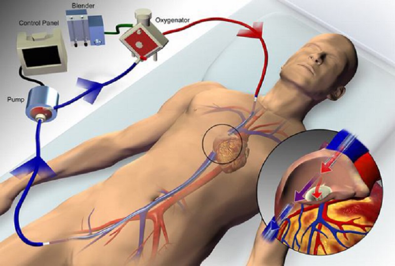 Pripojenie ECMO na krvný obeh pacienta