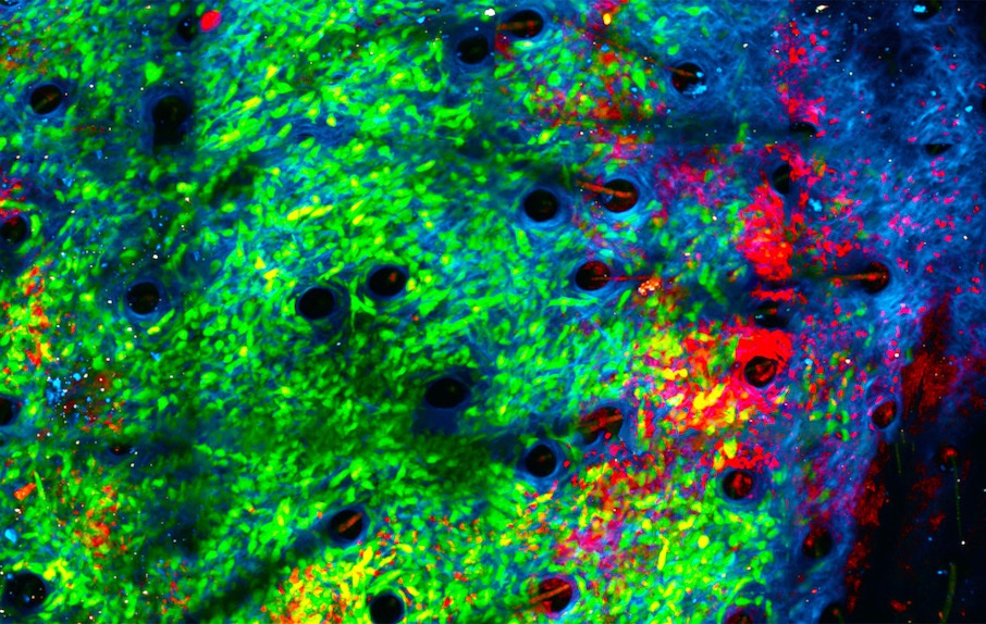 Rakovinné buňky (zeleně) napadené neutrofilními granulocyty (červeně) v kolagenové struktuře (modře) nádoru  Kredit: Jacqueline Baileyá / Dr Chtanova's Innate Tumour Immunology Lab at Garvan