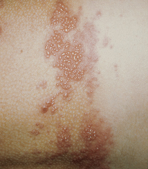 Pásovým oparem se projevuje reaktivovaný virus planých neštovic – varicella zoster virus (VZV)  Kredit: Fixi, Wikimedia Commons, CC BY-SA 3.0