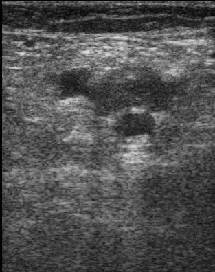 Ultrasonografický obraz žíl dolnej končatiny: v strede obrázku je pulzujúca tepna, nad ňou rozšírená  žila, vyplnená trombom, ktorá sa nedá stlačiť ultrasonografickou sondou tak, ako vľavo od nej žila bez trombózy. Kredit: M. Čiernik, Wikipedia, CC B