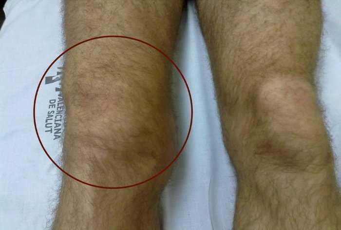 Hemartros- zakrvácanie do kolenného kĺbu, časté pri hemofílii. Kredit: Felipe Querol, et al., Apunts Med Esport. 2011.