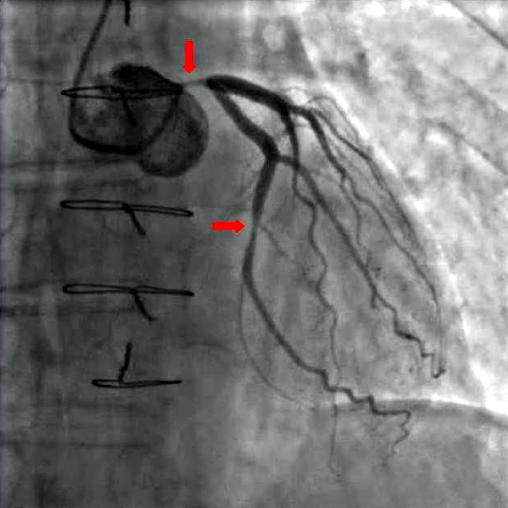 NĂˇlez zĂşĹľenĂ˝ch Ăşsekov koronĂˇrnych tepien na snĂ­mke z koronĂˇrnej angiografie. (Kredit: Wikimedia)