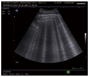 UltrazvukovĂ˝ obraz pri ĹĄaĹľkom srdcovom zlyhĂˇvanĂ­ - lĂşÄŤovitĂ© B -lĂ­nie pri ultrazvukovom vyĹˇetrenĂ­ hrudnĂ­ka   Kredit:  Luciano Cardinale et al., World J Radiol. 2014 June 28; 6(6): 230-237.