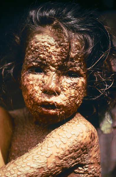 Pravé neštovice v Bangladéši, pár let před vymýcením. Kredit: CDC/James Hicks.