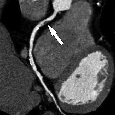 Zobrazenie zĂşĹľenej koronĂˇrnej tepny na snĂ­mke z CT koronĂˇrnej angiografie (Kredit: Coffscardiology.com)