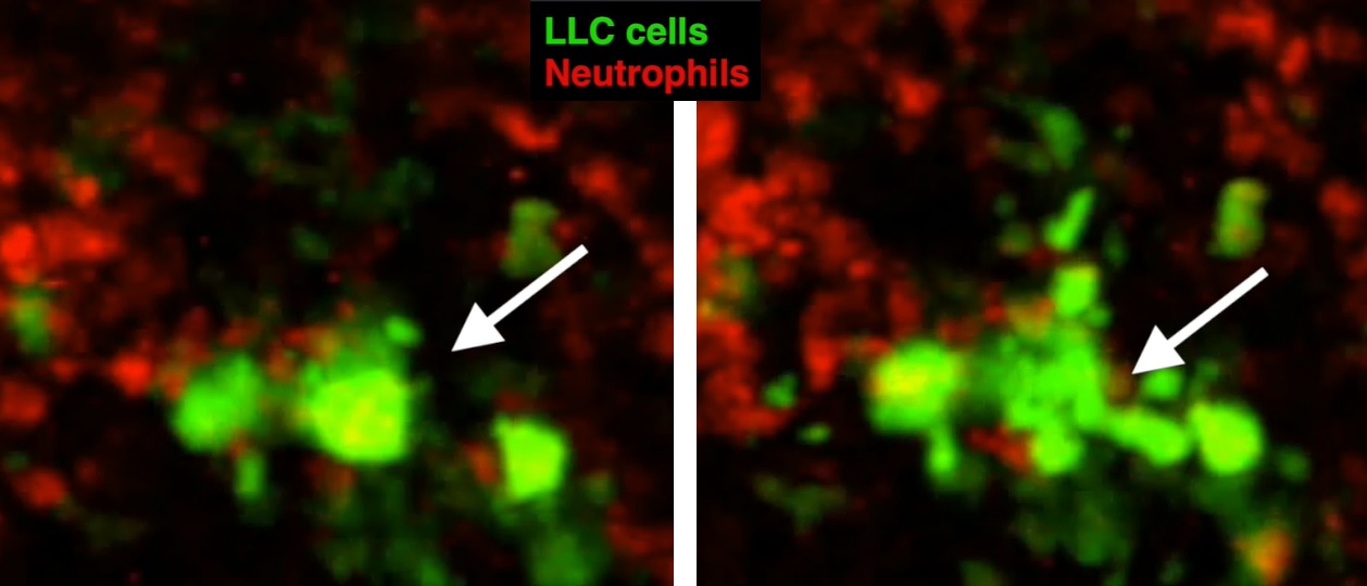 Interakce neutrofilních granulocytů s buňkami myšího Lewisova karcinomu plic vede k blebbingu – k rozvolnění nádorových buněk, pak k jejich segmentaci a pohlcení fagocyty, mezi které patří i neutrofily Kredit: Andrew O. Yam et al, Cancer Research 202