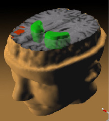 Snímek pozitronovou emisní tomografií (PET) zobrazuje anatomické a neurofyziologické změny na mozku člověka se  schizofrenní; předpokládá se, že mnohé příznaky jsou zapříčiněny zmenšeným objemem čelního laloku (červeně) a naopak zvýšenou hladinou dop