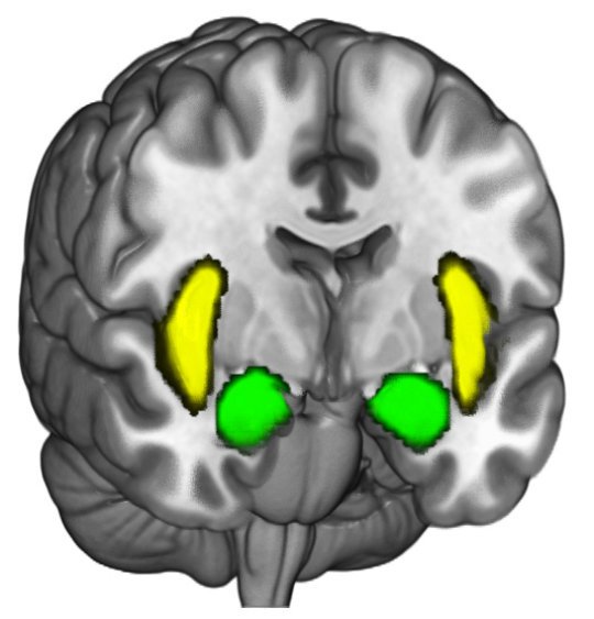 Když vládnou amygdala, tak končí rozumná debata. Kredit: Brain and Creativity Institut / USC.