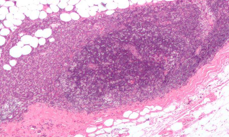 Mikrofotografie lymfatické uzliny. Nemocným karcinomem prsu (ženám i mužům) se rakovina  ráda šíří do vzdálených lymfatických uzlin. A právě v tom, co lze nazvat agresivitou a podepisováním rozsudku smrti, hraje významnou roli bisfenol S.  A nehraje 