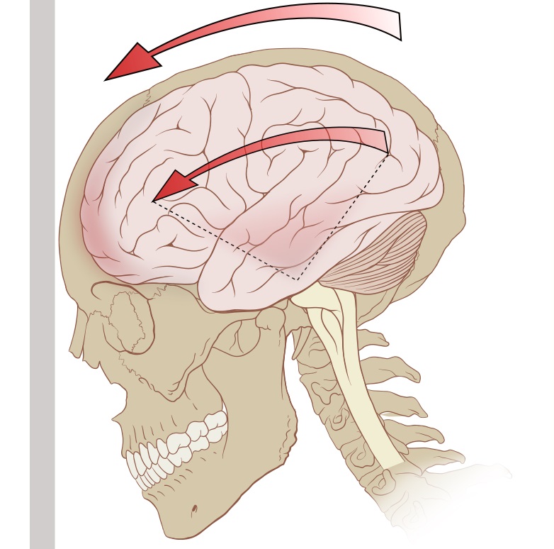Nejčastějším symptomem zvýšeného nitrolebního tlaku je bolest hlavy. Při pomalu se rozvíjející nitrolební hypertenzi, například při růstu mozkového nádoru, je nárůst intenzity bolestí hlavy pozvolné. Při krvácení do mozku je bolest okamžitá. V případ