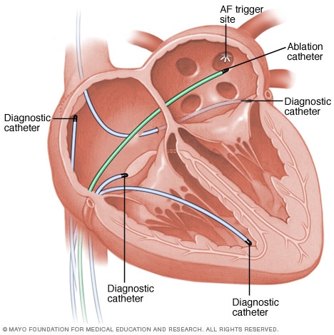Pri rádiofrekvenčnej ablácii je srdce plné katétrov – väčšina je diagnostických, umožňujúca snímanie a podrobnú analýzu elektrokardiogramu, jeden slúži na abláciu (na obrázku ten zelený). (Kredit: Mayo Faundation for Medical Education and Research).
