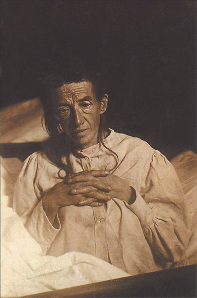 Auguste Deter, padesĂˇtiletĂˇ Ĺľena v roce 1902. PrvnĂ­ pĹ™Ă­pad osoby u nĂ­Ĺľ Alois Alzheimer tuto chorobu popsal. PozdÄ›ji nemoc podle objevitele dostala svĂ© jmĂ©no. (VolnĂ© dĂ­lo, Wikipedia)