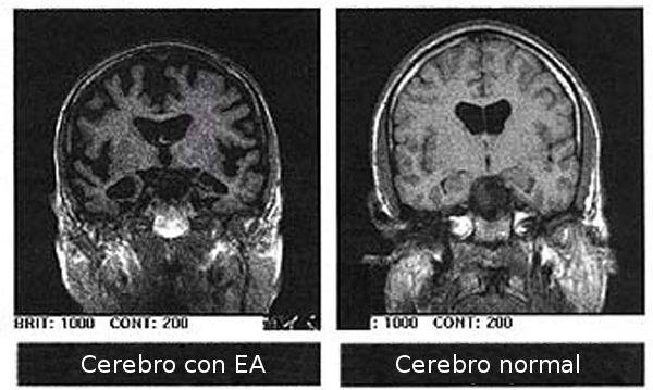 SnĂ­mkovĂˇnĂ­ MRI (magnetickĂˇ rezonance) lze u nemocnĂ˝ch AD odhalit celkovou atrofii mozku. Ta se projevĂ­ aĹľ v pokroÄŤilĂ©m stadiu nemoci. Vpravo je pro srovnĂˇnĂ­ mozek zdravĂ˝. (Kredit: Wikimedia,  CC BY-SA 3.0)