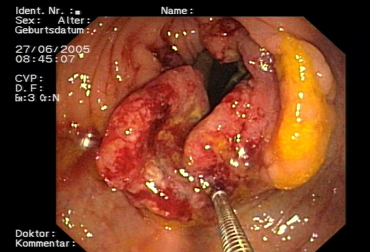 Karcinóm hrubého čreva - kolonoskopické vyšetrenie. Kredit: Doktor silke, CC BY-SA 3.0