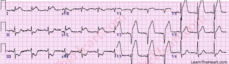 TypickĂ˝ obraz srdcovĂ©ho infarktu na EKG vyrieĹˇi problĂ©m raz a navĹľdy. Ak je vĹˇak elektrokardiogram negatĂ­vny, stanovenie alebo vylĂşÄŤenie ochorenia koronĂˇrnych tepien srdca mĂ´Ĺľe byĹĄ aj veÄľmi komplikovanĂ©