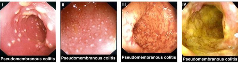 Čtyři fáze pseudomembranózní kolitidy na záznamu z kolonoskopie (zdroj: DELMÉE, M., et al. Epidemiology of Clostridium difficile toxinotype. Eurosurveillance 14 September 2006 , Volume 11, Issue 37)