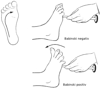 Babinského reflex, který se k diagnóze nemocných ALS občas používá, se nazývá podle objevitele, francouzského neurologa Josepha Babinskiho. Pokud lehce pohybujeme tupým předmětem po chodidle od paty k malíčku, normální reakcí zdravého dospělého člově