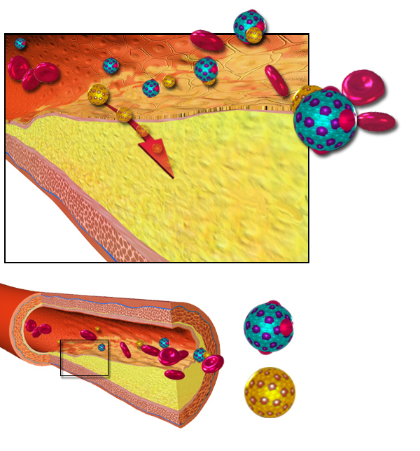 Ateroskleróza vzniká ukladaním lipoproteínov do cievnej steny, nasledovaným zápalovou reakciou. Kredit:  Bruce Blaus, Wikimedia, CC BY 3.0
