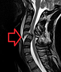 Poranenie krčnej chrbtice s tlakom úlomkov na miechu. Zobrazenie pomocou nukleárnej magnetickej rezonancie. Kredit: ?????? ??????? 86, Wikimedia Commons, CC BY-SA 3.0