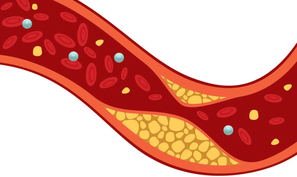 Prosím neplést  pojmy tuk s lipoproteinem. Lipoprotein přezdívaný „zlý cholesterol“ jednak není tukem a navíc je záležitostí „vnitřku“ cév, nikoli „vnějšku“, kterého se nový objev týká. Na obrázku je „usazenina cholesterolu“ zužující průtok krve cévo