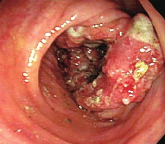 Kolonoskopický nález pokročilého karcinómu hrubého čreva. (Kredit: Fu K, et al., World J Gastroenterol)  DOI: 10.3748/wjg.v12.i47.7715]