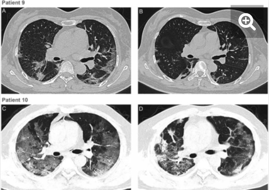 Snímky z vyšetření hrudníku dvou pacientů počítačovou tomografií. Nahoře pacient č. 9 před podáním transfúze a necelý týden poté. Vlevo je obraz „mléčně zakalený“ s patrnými lézemi poblíž pohrudnice. U obou pacientů je vpravo na snímcích patrný ústup