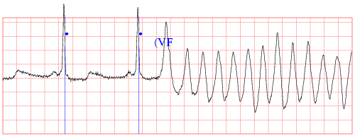 A je zle! EKG zĂˇznam z kardiomonitora zachytĂˇva dva poslednĂ© normĂˇlne sĹĄahy srdca (oznaÄŤenĂ© modrĂ˝mi bodkami) a potom komorovĂş fibrilĂˇciu (VF). Pacient upadol do klinickej smrti. (Kredit: Creighton University Ventricular Tachyarrhythmia Data