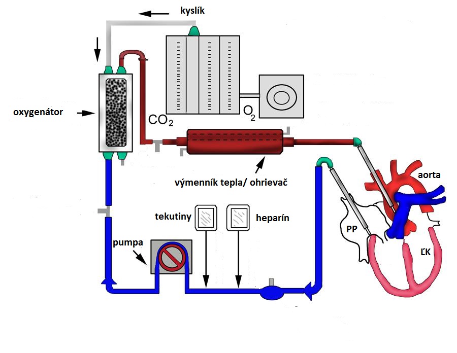 ECMO - mimotelovĂˇ oxygenĂˇcia krvi - schĂ©ma zapojenia zariadenia: krv je odoberanĂˇ z pravej predsiene, prechĂˇdza vĂ˝mennĂ­kom tepla, oxygenĂˇtorom, ÄŤerpadlom, doplnĂ­ sa podÄľa potreby o tekutinu a pridĂˇ sa heparĂ­n na znĂ­Ĺľenie zrĂˇĹľanlivost