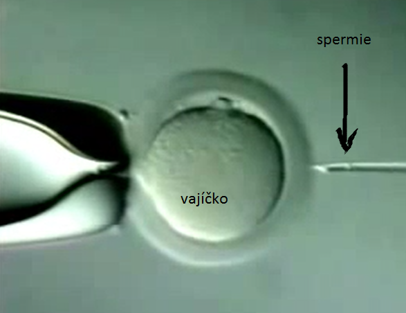 ICSI â€“ intracytoplasmic sperm injection