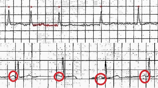 EKG záznam fibrilácie predsiení: nepravidelnosť činnosti srdca sa dá rozoznať ľahko, podstatné pre diagnózu je chýbanie P vlny na EKG - zakrúžkované na dolnej, normálnej krivke.