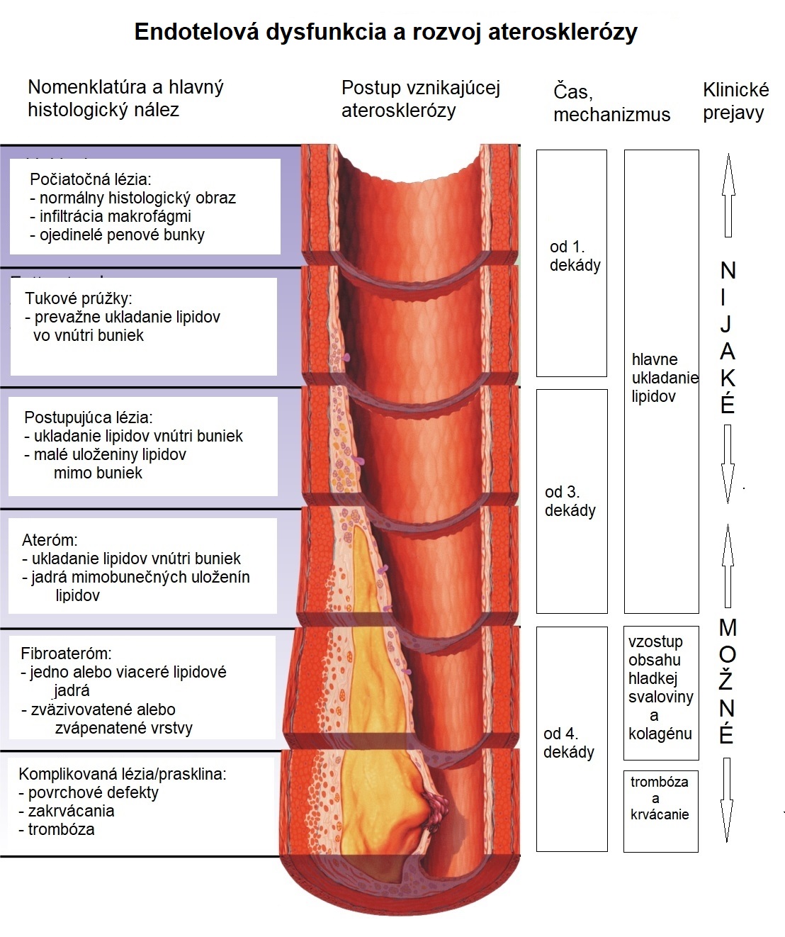 Endotelová dysfunkcia a rozvoj aterosklerózy. (Wikipedia – Endothelial dysfunction, Creative Commons Attribution-Share Alike 4.0 International)
