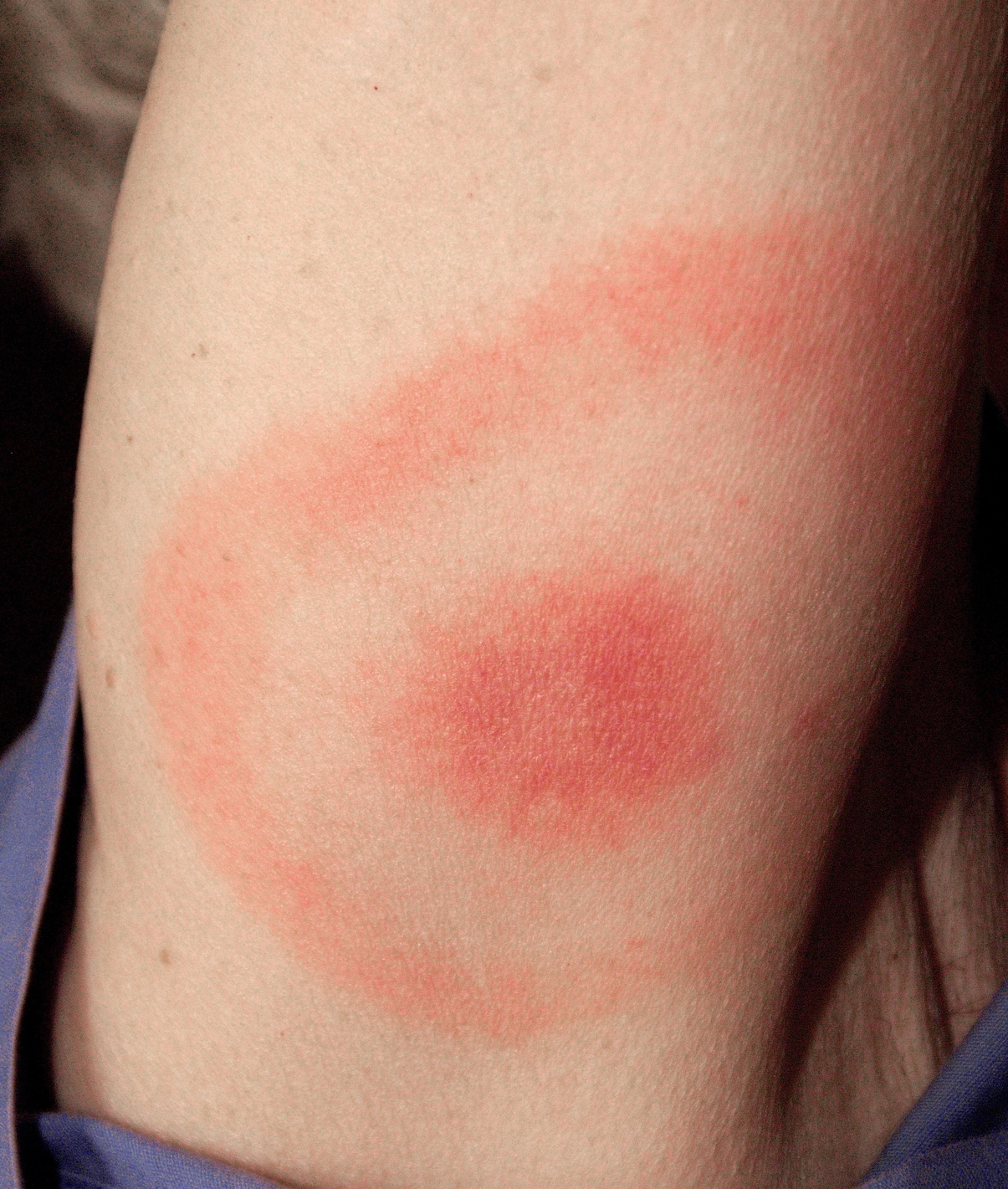 Typické začervenanie – erythema migrans pri boréliovej infekcii kože. Kredit: Hannah Garrison - en:User:Jongarrison CC BY-SA 2.5