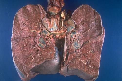 Bilaterální hilová lymfadenopatie - častý nález nemocných sarkoidózou. Zvětšené a zmnožené mízní uzliny. (tmavší a nazelenalá ložiska) v místech, kterým se odborně říká hily. To jsou místa kudy do plic vstupují bronchy (průdušky), cévy a nervy..  Kre