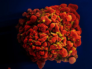 BĂ­lĂ© krvinky napadenĂ© virem HIV, obrĂˇzek z elektronovĂ©ho mikroskopu umÄ›le dobarveno. Kredit: NIAID