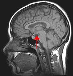 Hypothalamus, sídlo neuronů „POMC“, zodpovědných za pocit hladu.