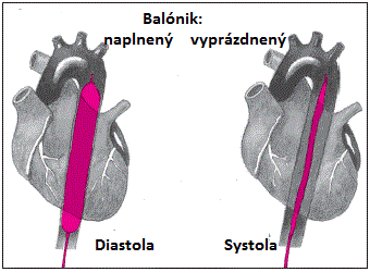 IABP - ÄŤinnosĹĄ balĂłnikovej pumpy v aorte: v diastole (medzi sĹĄahmi srdca) je balĂłnik naplnenĂ˝ hĂ©liom a krv vytlaÄŤenĂˇ z aorty; v systole (pri sĹĄahu srdca) je balĂłnik vyprĂˇzdnenĂ˝ a aorta sa plnĂ­ krvou zo srdca. (Kredit: FDA)