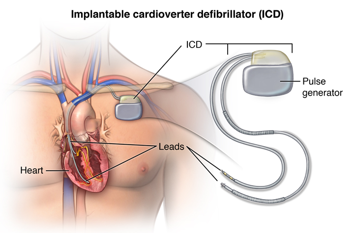 ImplantovateÄľnĂ˝ kardioverter - defibrilĂˇtor dokĂˇĹľe aj viackrĂˇt zachrĂˇniĹĄ pacientovi Ĺľivot.  Ale sĂş situĂˇcie, kedy je vhodnĂ© toto zariadenie vypnĂşĹĄ