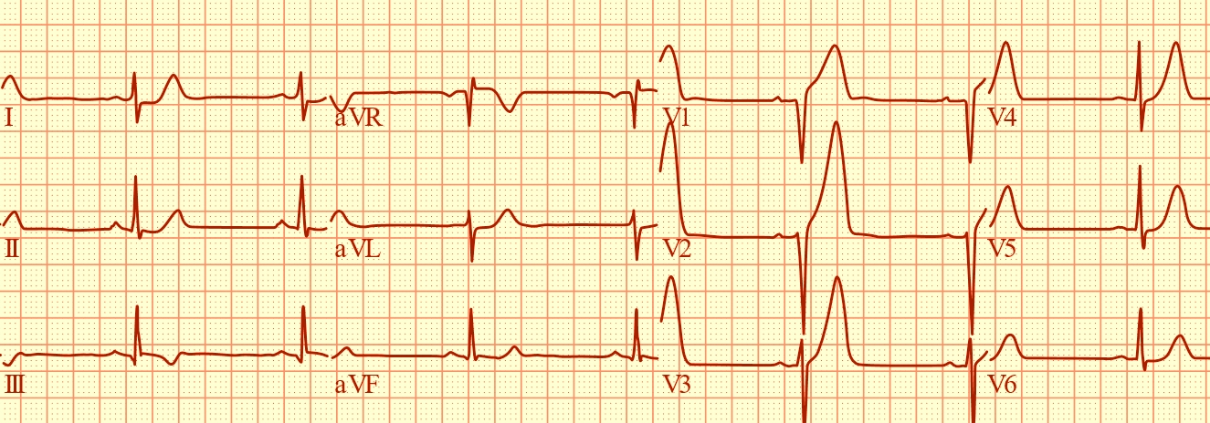 EKG obraz predného infarktu myokardu. Elektrokardiografia znamenala prvý prielom v diagnostike infarktu.