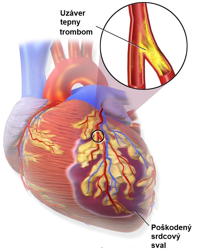Na poÄŤiatku infarktu je vznik krvnej zrazeniny - trombĂłza koronĂˇrnej tepny.
