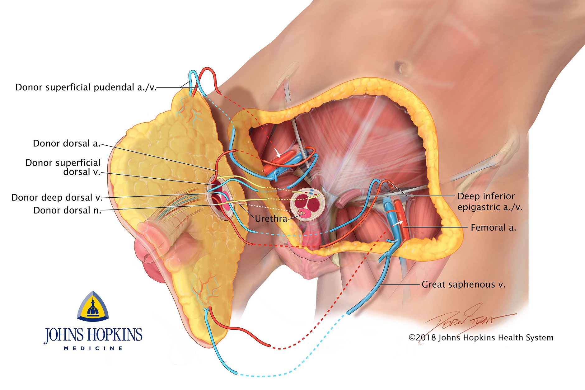 Schéma transplantace penisu. Kredit: Devon Stuart pro Johns Hopkins Medicine.