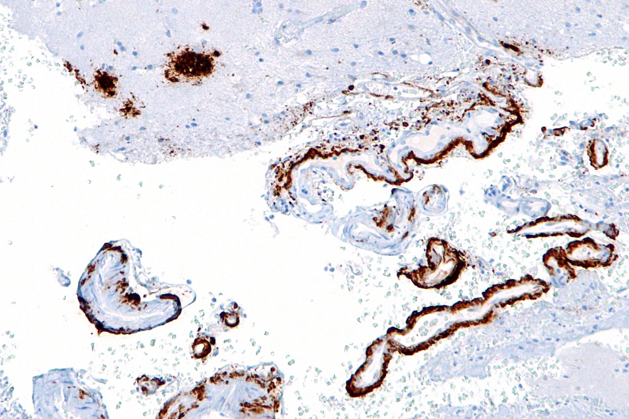 U zemĹ™elĂ˝ch na Alzheimerovu chorobu (AD), lze v mozkovĂ© kĹŻĹ™e snadno najĂ­t okrsky s nahromadÄ›nĂ˝m amyloidem beta. Na preparĂˇtu se zbarvujĂ­ hnÄ›dÄ›. (Kredit Nefron, Wikipedia CC BY-SA 3.0)