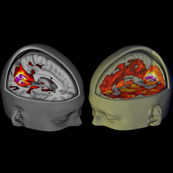 Vlevo mozek na placebu, vpravo LSD. Kredit: Imperial College
