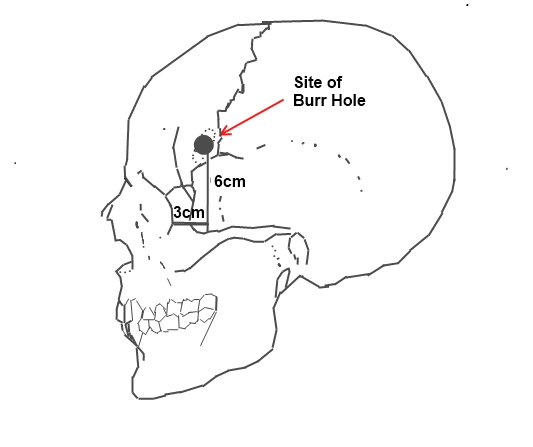 MĂ­sto vrtu pĹ™i pre-frontĂˇlnĂ­ lobotomii propagovanĂ© doktory Freemanem a Wattsem.  (Kredit: FiachraByrne, Wikipedia, CC BY-SA 3.0)