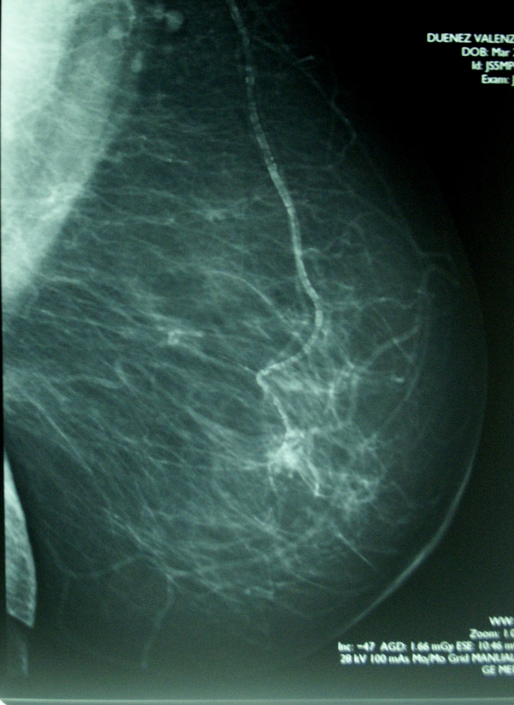 Ukázka mammogramu prsu v ML projekci. Po vakcinaci se u mnoha žen na snímku zmnoží řada různě velkých světlých lokalit, které toto vyšetření nedovoluje odlišit od ložisek šířící se rakoviny. Kredit: volné dílo.